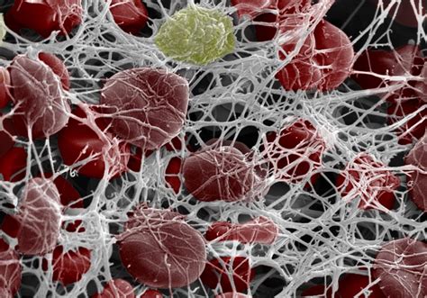 White Fibrous Clots and VAERS Data Manipulation: A Call for Urgent Investigation